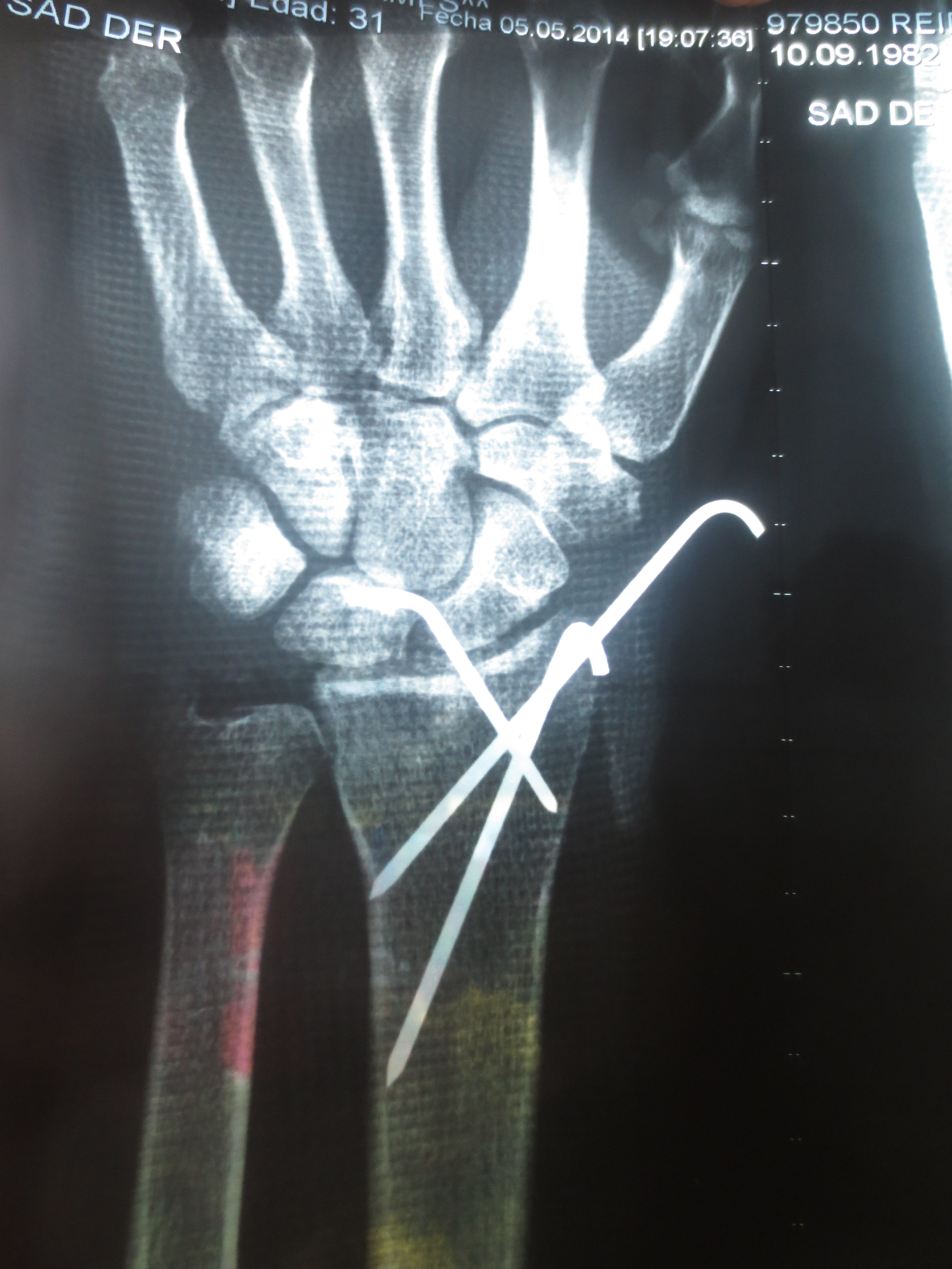 Broken Wrist XRay Damage Death Road